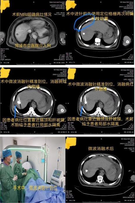 菏澤市立醫院介入科：開展微波消融術 造福腫瘤患者